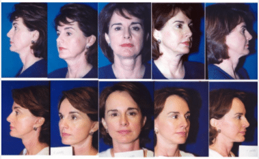 46 Year Old Facelift Before & After Photos