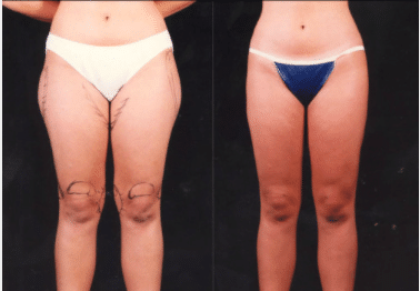 Thigh Liposuction Before & After Photo